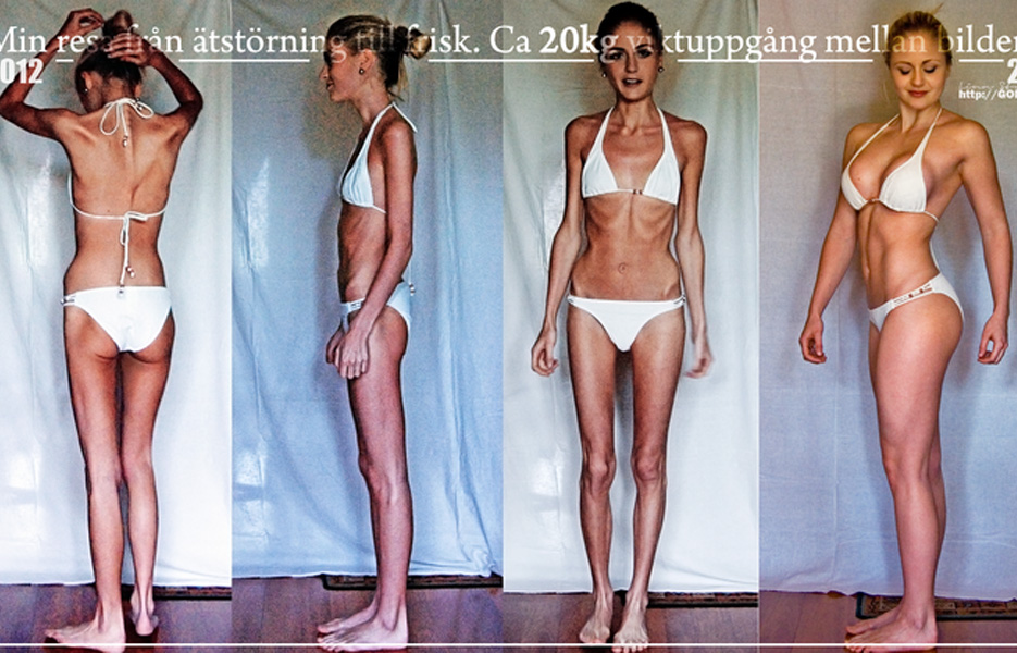 linn-stromberg-anorexia-before-and-after